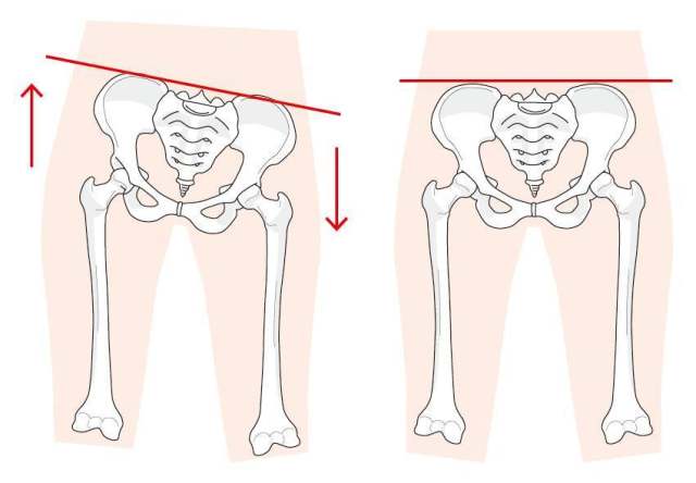 骨盆扭曲