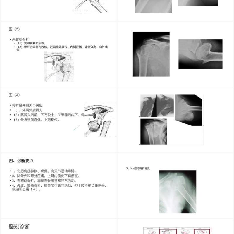 蓝色肱骨外科颈骨折PPT模板