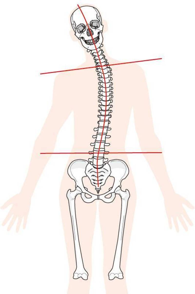 脊柱扭曲
