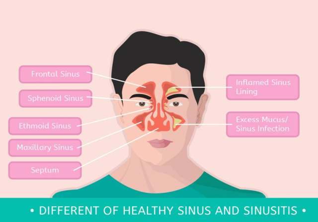 不同的健康窦和鼻窦炎