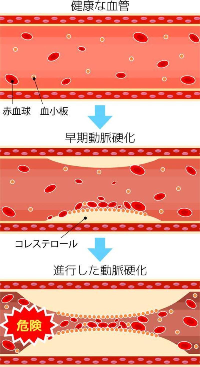 动脉硬化的进展