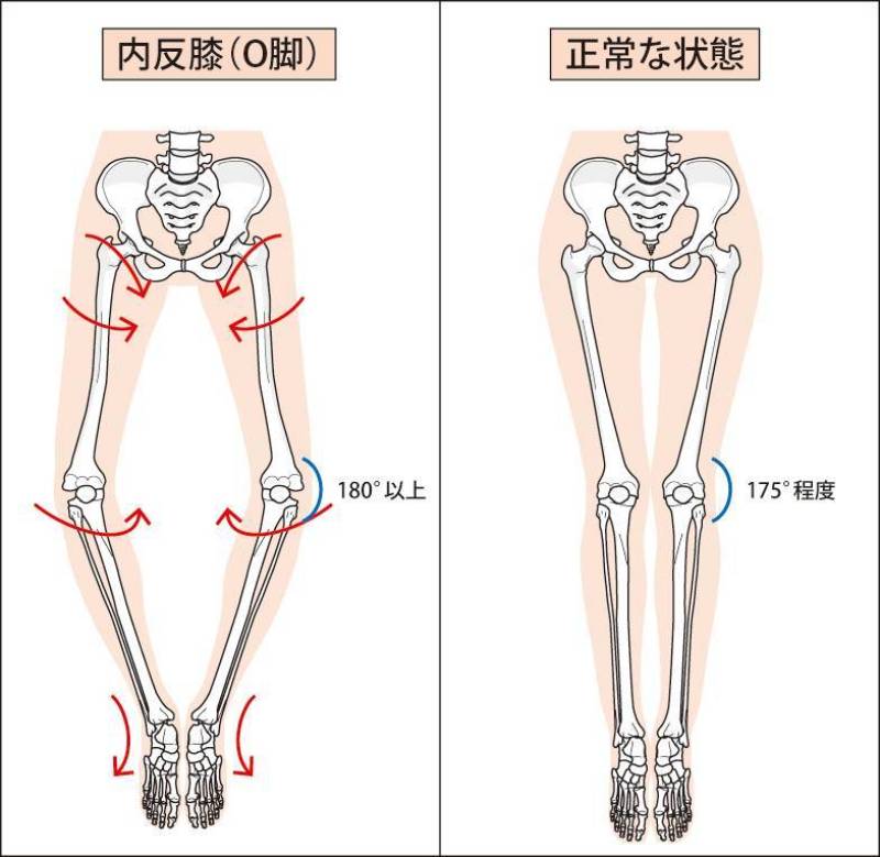 膝关节的排列异常