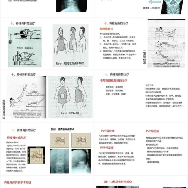 蓝色卡通风脊柱骨折与脊髓损伤PPT模板