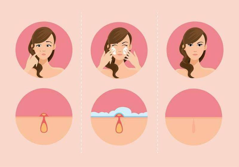 女孩和青春痘 矢量