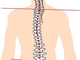 脊柱扭曲