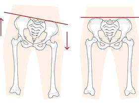骨盆扭曲