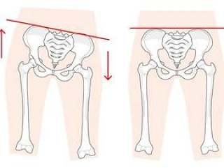 骨盆扭曲