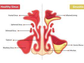 健康的鼻窦和鼻窦炎