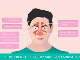 不同的健康窦和鼻窦炎