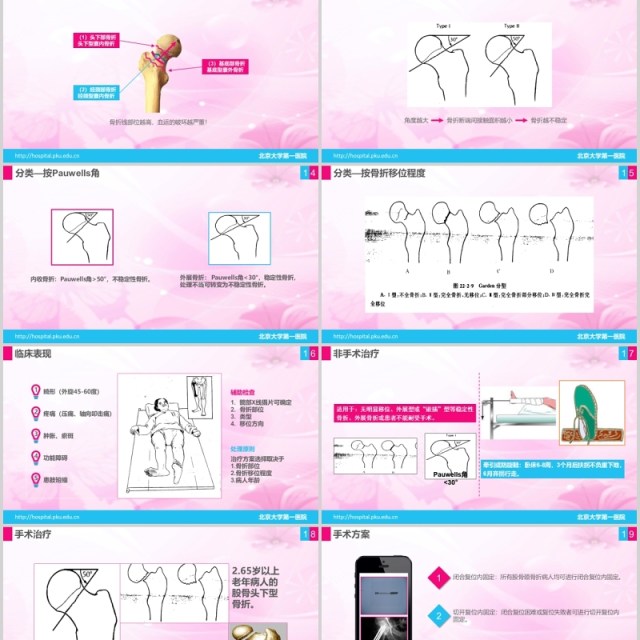 简洁医院医疗股骨颈骨折护理查房PPT模板