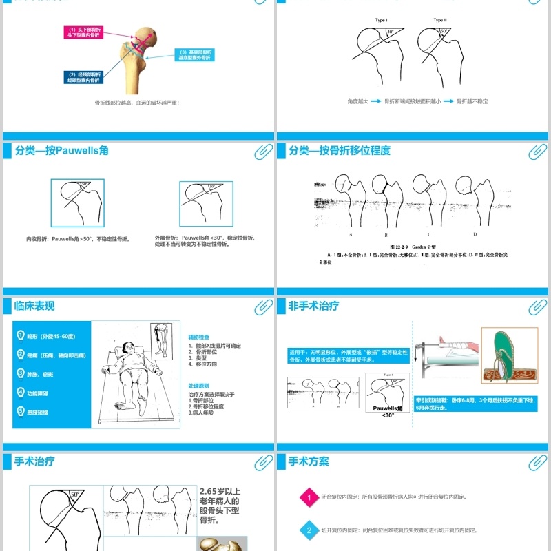 蓝色课件股骨颈骨折护理查房PPT模板